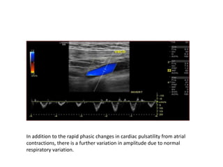 In addition to the rapid phasic changes in cardiac pulsatility from atrial
contractions, there is a further variation in amplitude due to normal
respiratory variation.
 