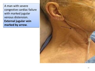 Pulse In Head PPT Jugular Venous Pulse And Carotid Arterial Pulse, 40% OFF
