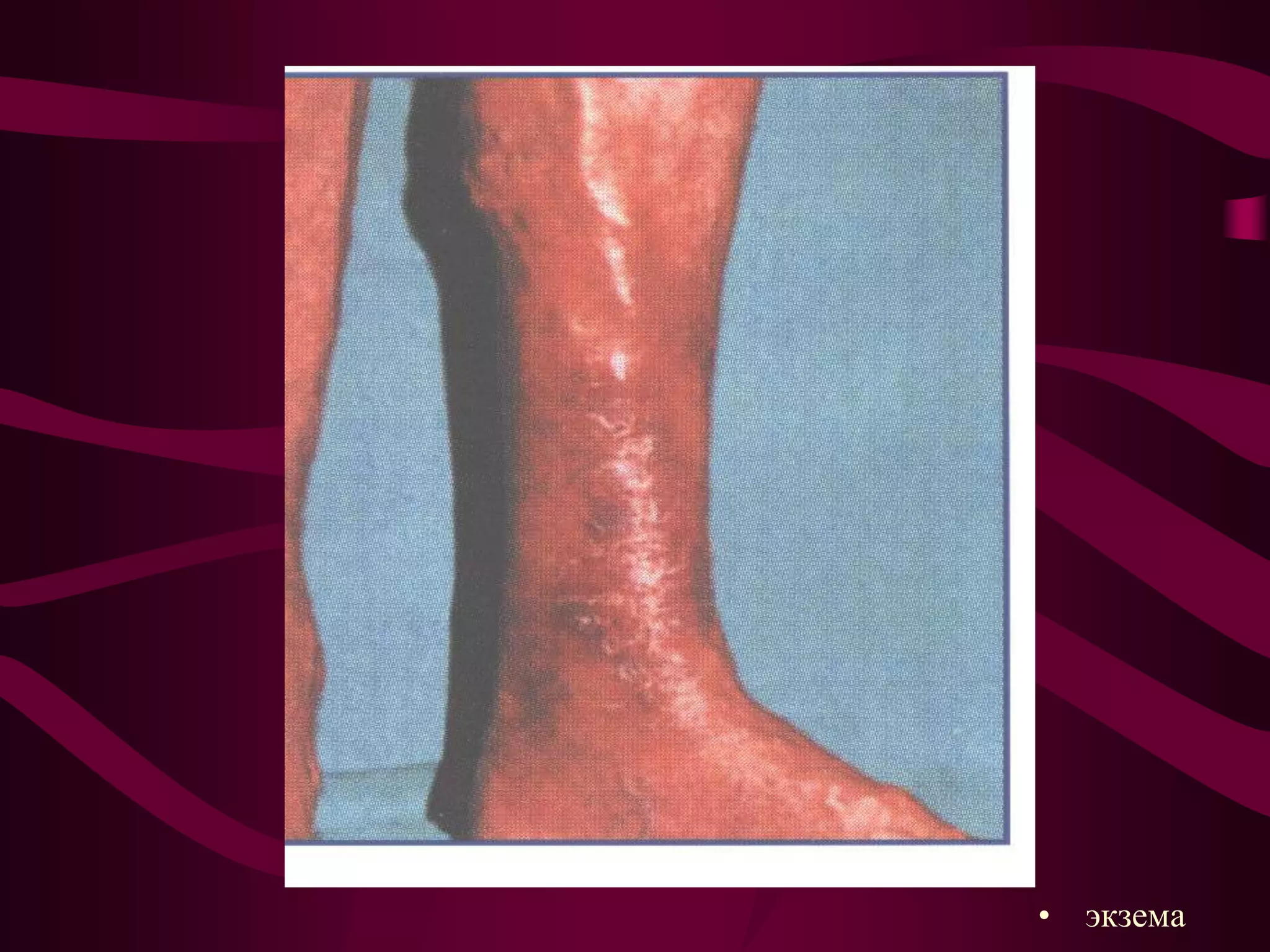 Pathogenesis chronic venous insufficiency