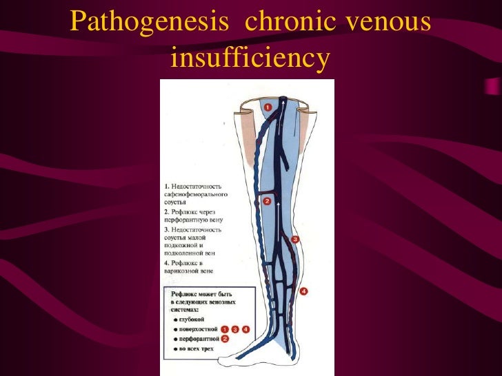 Venous insufficiency