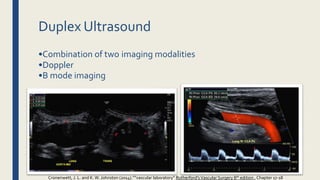 Duplex Ultrasound
•Combination of two imaging modalities
•Doppler
•B mode imaging
Cronenwett, J. L. and K.W. Johnston (2014).””vascular laboratory” Rutherford'sVascular Surgery 8th edition , Chapter 17-18
 
