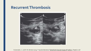 RecurrentThrombosis
Cronenwett, J. L. and K.W. Johnston (2014).””vascular laboratory” Rutherford'sVascular Surgery 8th edition , Chapter 17-18
 