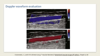 Doppler waveform evaluation
Cronenwett, J. L. and K.W. Johnston (2014).””vascular laboratory” Rutherford'sVascular Surgery 8th edition , Chapter 17-18
 