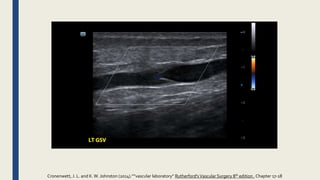 Cronenwett, J. L. and K.W. Johnston (2014).””vascular laboratory” Rutherford'sVascular Surgery 8th edition , Chapter 17-18
 