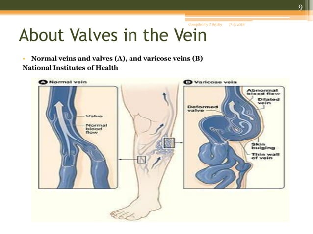 Venous stasis ulcers | PPT