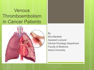 Venous
Thromboembolism
in Cancer Patients
By
Dina Barakat
Assistant Lecturer
Clinical Oncology Department
Faculty of Medicine
Assiut University
 