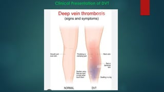 Clinical Presentation of DVT
 