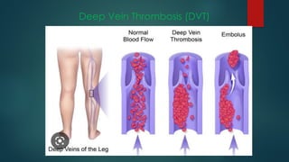 Deep Vein Thrombosis (DVT)
 