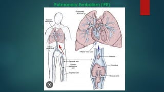 Pulmonary Embolism (PE)
 