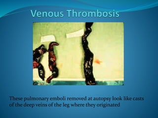 These pulmonary emboli removed at autopsy look like casts
of the deep veins of the leg where they originated
 