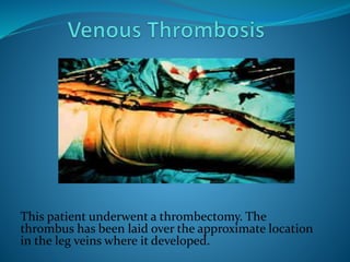 This patient underwent a thrombectomy. The
thrombus has been laid over the approximate location
in the leg veins where it developed.
 