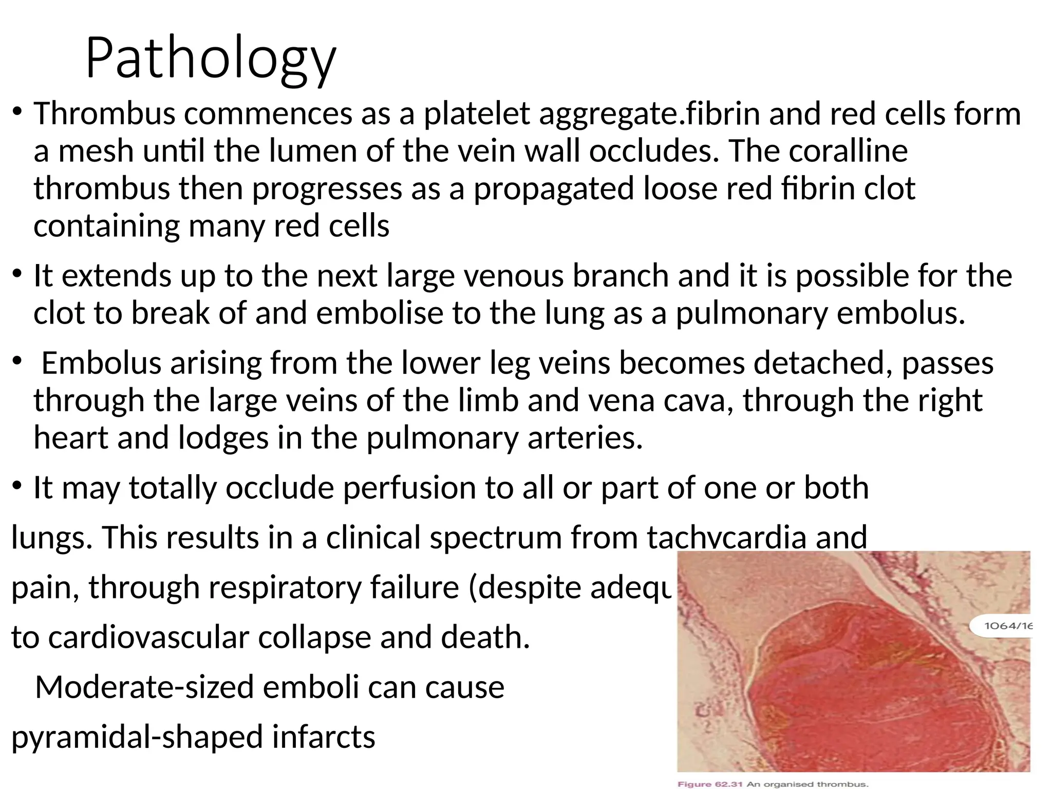 Pathology
• Thrombus commences as a platelet aggregate.fibrin and red cells form
a mesh until the lumen of the vein wall occludes. The coralline
thrombus then progresses as a propagated loose red fibrin clot
containing many red cells
• It extends up to the next large venous branch and it is possible for the
clot to break of and embolise to the lung as a pulmonary embolus.
• Embolus arising from the lower leg veins becomes detached, passes
through the large veins of the limb and vena cava, through the right
heart and lodges in the pulmonary arteries.
• It may totally occlude perfusion to all or part of one or both
lungs. This results in a clinical spectrum from tachycardia and
pain, through respiratory failure (despite adequate ventilation)
to cardiovascular collapse and death.
Moderate-sized emboli can cause
pyramidal-shaped infarcts
 