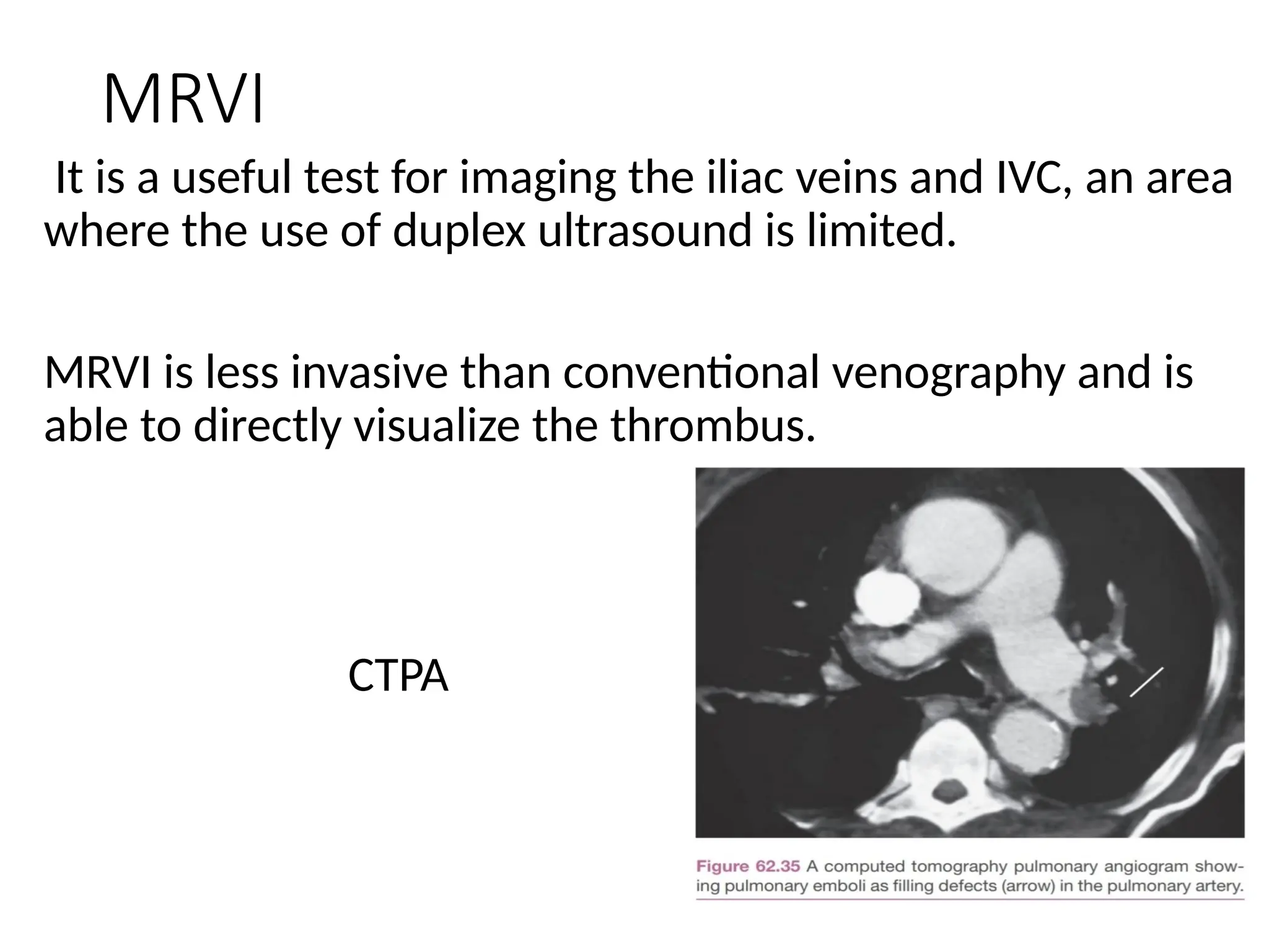 MRVI
It is a useful test for imaging the iliac veins and IVC, an area
where the use of duplex ultrasound is limited.
MRVI is less invasive than conventional venography and is
able to directly visualize the thrombus.
CTPA
 