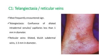 C1: Telangiectasia / reticular veins
Most frequently encountered sign.
Telangiectasia: Confluence of dilated
intradermal venules/ capillaries less than 1
mm in diameter.
Reticular veins: Dilated, bluish subdermal
veins, 1-3 mm in diameter.
 