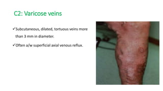 C2: Varicose veins
Subcutaneous, dilated, tortuous veins more
than 3 mm in diameter.
Often a/w superficial axial venous reflux.
 