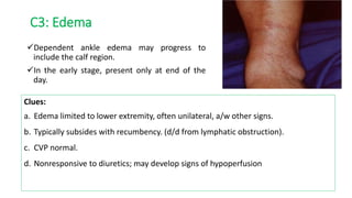 C3: Edema
Dependent ankle edema may progress to
include the calf region.
In the early stage, present only at end of the
day.
Clues:
a. Edema limited to lower extremity, often unilateral, a/w other signs.
b. Typically subsides with recumbency. (d/d from lymphatic obstruction).
c. CVP normal.
d. Nonresponsive to diuretics; may develop signs of hypoperfusion
 