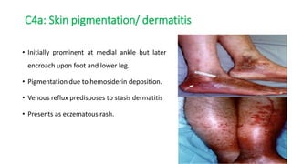 C4a: Skin pigmentation/ dermatitis
• Initially prominent at medial ankle but later
encroach upon foot and lower leg.
• Pigmentation due to hemosiderin deposition.
• Venous reflux predisposes to stasis dermatitis
• Presents as eczematous rash.
 