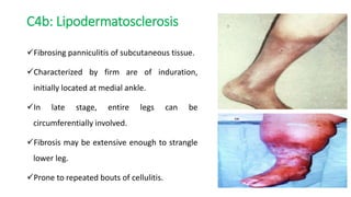 C4b: Lipodermatosclerosis
Fibrosing panniculitis of subcutaneous tissue.
Characterized by firm are of induration,
initially located at medial ankle.
In late stage, entire legs can be
circumferentially involved.
Fibrosis may be extensive enough to strangle
lower leg.
Prone to repeated bouts of cellulitis.
 
