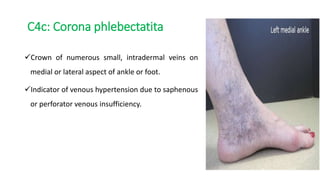 C4c: Corona phlebectatita
Crown of numerous small, intradermal veins on
medial or lateral aspect of ankle or foot.
Indicator of venous hypertension due to saphenous
or perforator venous insufficiency.
 