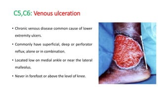 C5,C6: Venous ulceration
• Chronic venous disease common cause of lower
extremity ulcers.
• Commonly have superficial, deep or perforator
reflux; alone or in combination.
• Located low on medial ankle or near the lateral
malleolus.
• Never in forefoot or above the level of knee.
 