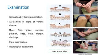 Examination
• General and systemic examination.
• Assessment of signs of venous
disease.
• Ulcer: Size, shape, number,
position, edge, base, margin,
discharge.
• Pulse examination.
• Neurological assessment
Types of ulcer edges
 