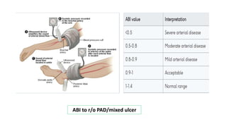 ABI to r/o PAD/mixed ulcer
 