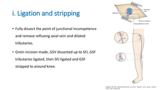 i. Ligation and stripping
• Fully dissect the point of junctional incompetence
and remove refluxing axial vein and dilated
tributaries.
• Groin incision made, GSV dissected up to SFJ, GSF
tributaries ligated, then SFJ ligated and GSF
stripped to around knee.
 