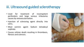 iii. Ultrasound guided sclerotherapy
• Used for treatment of incompetent
perforators and large venous tributaries
causes by neovascularisation.
• Injection of sclerosing agent directly into
veins.
• Most commn agent: Sodium tetradecyl
sulphate.
• Causes cellular death resulting in thrombosis,
fibrosis and sclerosis.
 
