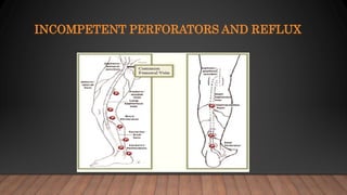INCOMPETENT PERFORATORS AND REFLUX
 