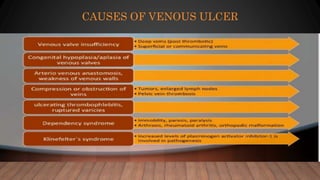 CAUSES OF VENOUS ULCER
 