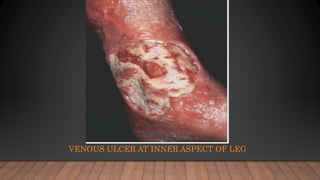 VENOUS ULCER AT INNER ASPECT OF LEG
 