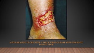A NON HEALING ULCER WITH A THICK FIBROUS BASE WITH NECROTIC
TURGID EDGE
 