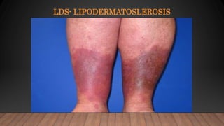 LDS- LIPODERMATOSLEROSIS
 
