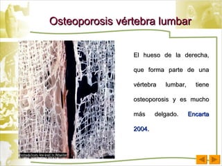 Osteoporosis vértebra lumbar El hueso de la derecha, que forma parte de una vértebra lumbar, tiene osteoporosis y es mucho más delgado.  Encarta 2004. 