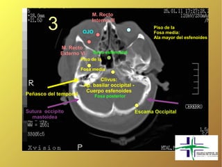 M. Recto

        3               OJO
                            Interno III
                                                         Piso de la
                                                         Fosa media:
                                                         Ala mayor del esfenoides

             M. Recto
             Externo VI      Seno esfenoidal
                       Piso de la

                       Fosa media

                               Clivus:
                        Ap. basilar occipital -
                         Cuerpo esfenoides
Peñasco del temporal          Fosa posterior


Sutura occipito                                   Escama Occipital
  mastoidea
 