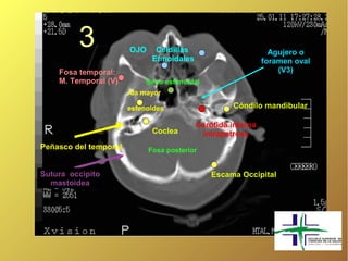 3             OJO     Celdillas
                              Etmoidales
                                                                Agujero o
                                                              foramen oval
    Fosa temporal:                                                (V3)
    M. Temporal (V)         Seno esfenoidal
                       Ala mayor

                       esfenoides                   Cóndilo mandibular

                                           Carótida interna
                              Coclea        intrapetrosa
Peñasco del temporal         Fosa posterior


Sutura occipito                                Escama Occipital
  mastoidea
 