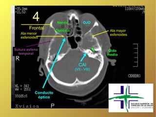 4            Nervio           OJO
        Frontal       Óptico II                   Ala mayor
   Ala menor                                      esfenoides
   esfenoides


Sutura esfeno                                    Oído
  temporal                                       medio

                                    CAI
                                  (VII - VIII)




           Conducto
            óptico
 