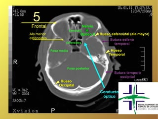 5
 Frontal                             Nervio
                          Etmoides
Ala menor                        Óptico II    Hueso esfenoidal (ala mayor)
esfenoides                                         Sutura esfeno
                      Esfenoides                     temporal
             Fosa media                             Hueso
                                                   Temporal


                      Fosa posterior
                                                      Sutura temporo
                                                         occipital
                  Hueso
                 Occipital
                                              Conducto
                                               óptico
 