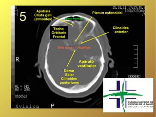 Apófisis

5
                                              Planun esfenoidal
    Crista galli
    (etmoides)          Seno frontal


                Techo                                    Clinoides
               Orbitario                                  anterior
                Frontal


                   Silla turca: * Hipófisis



                                  Aparato
                                 vestibular
                      Dorso
                        Selar
                     Clinoides
                    posteriores
 