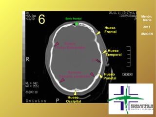 6         Seno frontal


                                     Hueso
                                                 Menón,
                                                  Mario

                                                  2011
                                     Frontal
                                                 UNICEN


         Sutura
    Fronto Esfenoidal
                                       Hueso
                                      Temporal
                            ¿?




                                 ?
           Suturas
                                     Hueso
      Occipito parietales
                                     Parietal




           Hueso
          Occipital
 