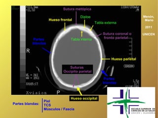 Sutura metópica

                                       Diploe                               Menón,
                     Hueso frontal                                           Mario
                                                 Tabla externa
                                                                             2011

                                                      Sutura coronal o      UNICEN
           Partes                Tabla interna        fronto parietal
           blandas



                                                           Hueso parietal

                                Suturas
                             Occipito parietal

                                                     Partes
                                                     blandas



                                 Hueso occipital
                  Piel
Partes blandas:   TCS
                  Músculos / Fascia
 