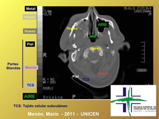 Metal

          Hueso

                                                        AIRE
                                Hueso
          Hueso
                                                 AIRE

           Piel
                                                 Hueso



Partes
Blandas   Músculo

                                                        Músculo
                                    Piel
                                           TCS
           TCS


          AIRE
   TCS: Tejido celular subcutáneo

           Menón, Mario - 2011 - UNICEN
 
