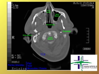 Fosa
                                   Nasal
                                                 Seno
                                                Maxilar




                                   Rinofaringe



                                                          Parótida
             Oído externo
                                       Canal
                                      Medular




                             TCS


                  Piel
Partes blandas:   TCS
                  Músculos / Fascia
 