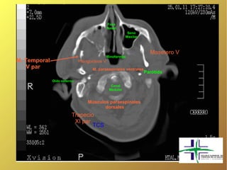 Fosa
                                              Nasal
                                                          Seno
                                                         Maxilar



                                                                     Masetero V
                                              Rinofaringe
M. Temporal                  Pterigoideos V
    V par                           M. paraespinales ventrales
                                                                   Parótida
              Oído externo
                                                Canal
                                               Medular


                                 Músculos paraespinales
                                        dorsales
                        Trapecio
                         XI par
                                TCS
 