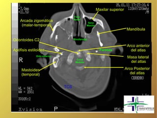 Maxilar superior
                                  Fosa
                                  Nasal
    Arcada zigomática                         Seno
     (malar-temporal)                        Maxilar
                                                                           Mandíbula

Odontoides C2                     Rinofaringe

                                                                           Arco anterior
Apófisis estiloides                                      Parótida            del atlas
             Oído externo
                                                                           Masa lateral
                                    Canal
                                   Medular                                  del atlas

     Mastoides                                                            Arco Posterior
     (temporal)                                                              del atlas


                            TCS
 
