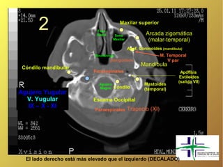 2                      Fosa
                              Nasal
                                             Maxilar superior

                                          Seno              Arcada zigomática
                                         Maxilar             (malar-temporal)
                                                   Apof. Coronoides (mandíbula)
                             Rinofaringe                           M. Temporal
                                      pterigoideos                    V par
                                                          Mandíbula
 Cóndilo mandibular
                            Paraespinales                                     Apófisis
                                                                             Estiloides
                                                                             (salida VII)
                               Agujero                     Mastoides
                               Magno     Cóndilo           (temporal)
Agujero Yugular
  V. Yugular                Escama Occipital
  IX – X - XI                                      Trapecio (XI)
                             Paraespinales




  El lado derecho está más elevado que el izquierdo (DECALADO)
 