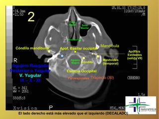 2                      Fosa
                               Nasal       Seno
                                          Maxilar



                              Rinofaringe

                                                         Mandíbula
  Cóndilo mandibular     Apof. Basilar occipital
                                                                        Apófisis
                                                                       Estiloides
                                                                       (salida VII)
                                Agujero                   Mastoides
                                Magno     Cóndilo         (temporal)
 Agujero Rasgado
Posterior o Yugular          Escama Occipital
    V. Yugular                                      Trapecio (XI)
                              Paraespinales
    IX – X - XI




   El lado derecho está más elevado que el izquierdo (DECALADO)
 