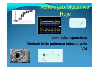 Pressure [cmH2O]
10 20 30 40 6050
TotalRecuitment[%]
0
Ventilação Mecânica
Hoje
Ventilação espontânea
Diminuir lesão pulmonar induzida pela
VM
C
A
B D
 