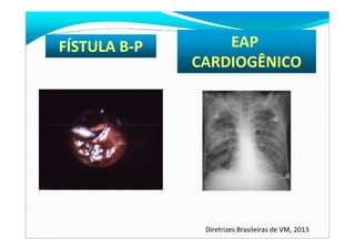 FÍSTULA B-P EAP
CARDIOGÊNICO
Diretrizes Brasileiras de VM, 2013
 