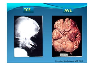 TCE AVE
Diretrizes Brasileiras de VM, 2013
 
